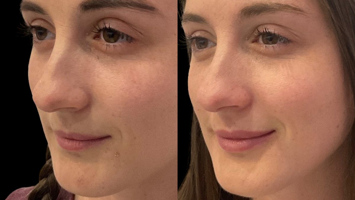 Lip Filler Before & After Gallery - Patient 112773 - Image 1