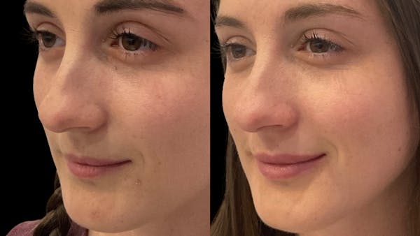 Lip Filler Before & After Gallery - Patient 112773 - Image 1