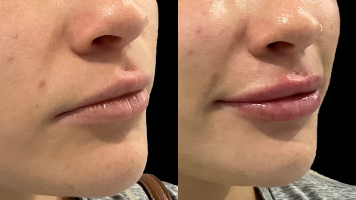 Lip Filler Before & After Gallery - Patient 857040 - Image 1