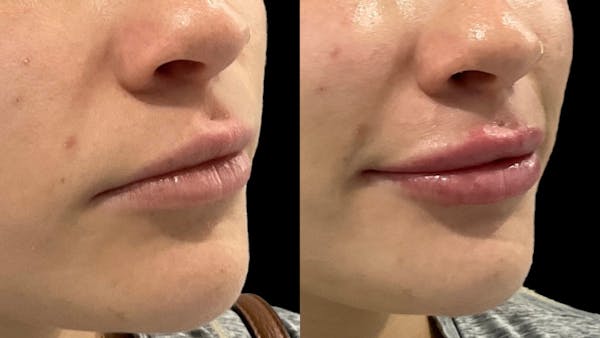 Lip Filler Before & After Gallery - Patient 857040 - Image 1
