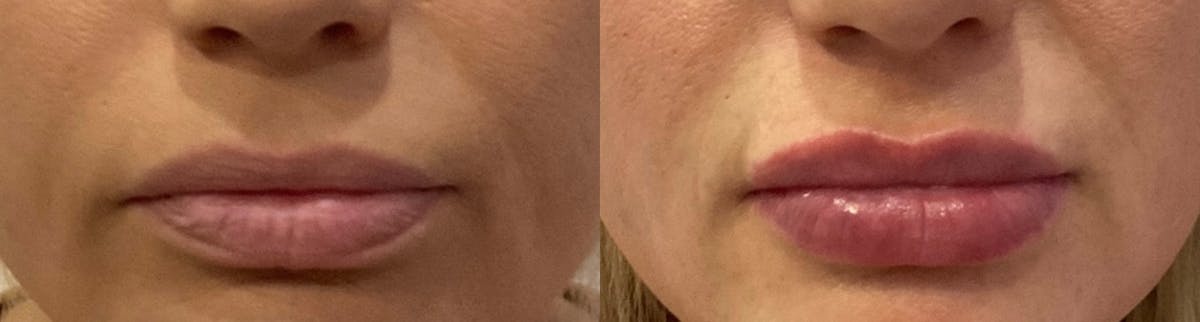 Lip Filler Before & After Gallery - Patient 349480 - Image 1