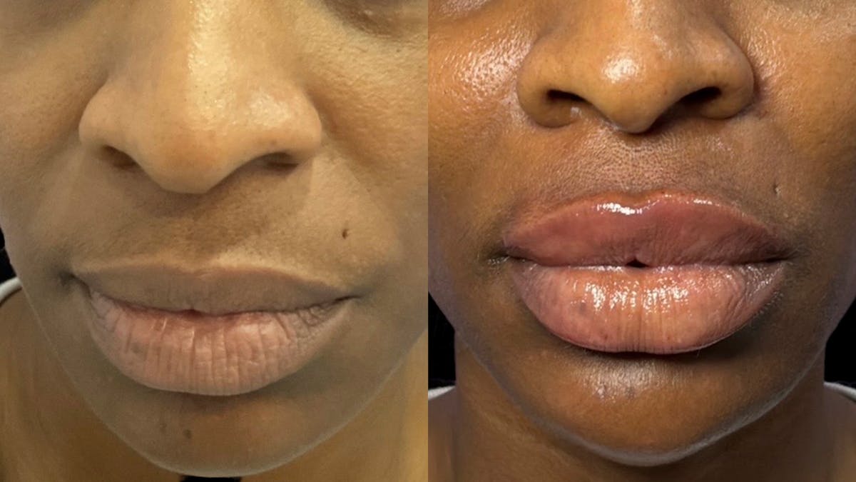 Lip Filler Before & After Gallery - Patient 258310 - Image 2