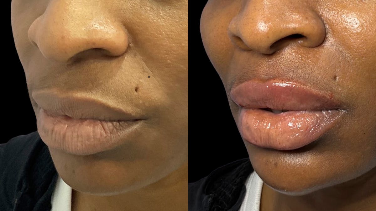 Lip Filler