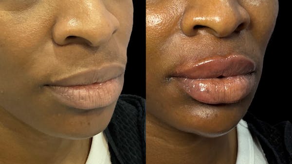 Lip Filler Before & After Gallery - Patient 258310 - Image 1