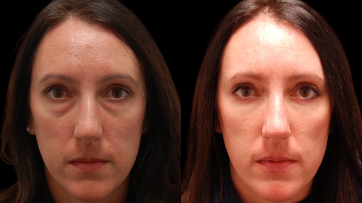 Lower Eyelid Surgery Before & After Gallery - Patient 112109 - Image 2