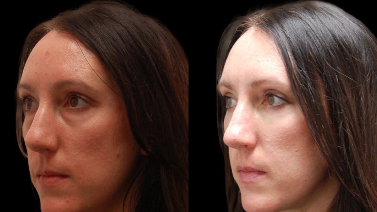 Lower Eyelid Surgery Before & After Gallery - Patient 112109 - Image 1
