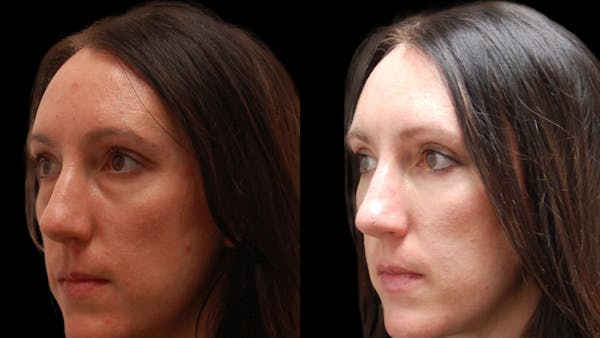 Lower Eyelid Surgery Before & After Gallery - Patient 112109 - Image 1