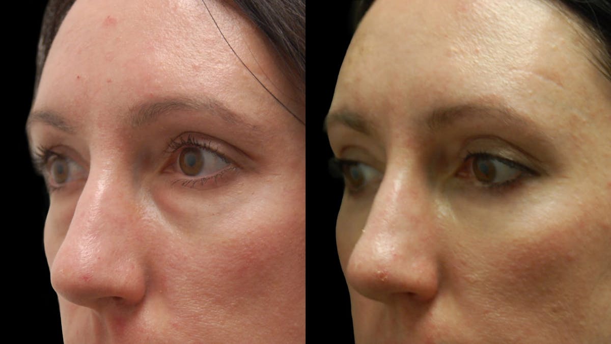 Lower Eyelid Surgery Before & After Gallery - Patient 112109 - Image 9