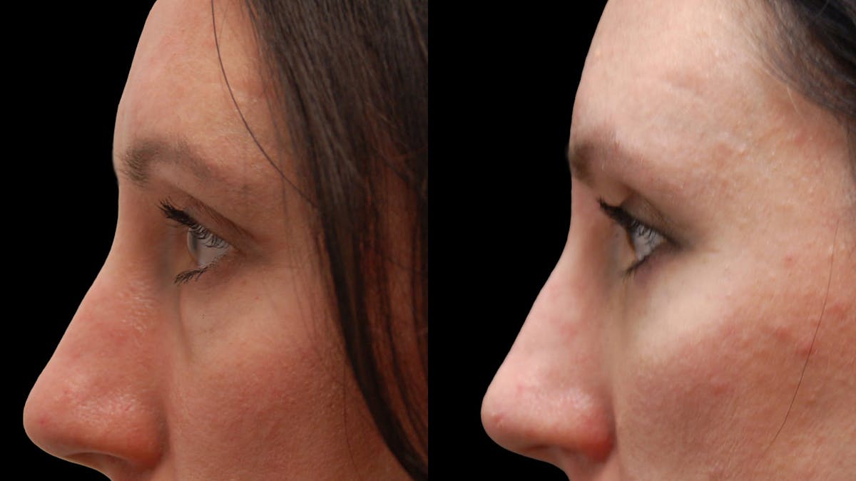 Lower Eyelid Surgery Before & After Gallery - Patient 112109 - Image 5