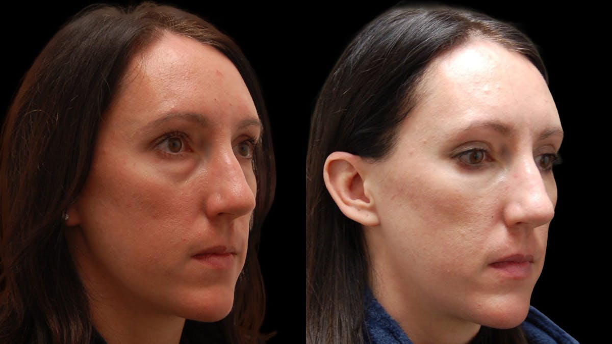 Lower Eyelid Surgery Before & After Gallery - Patient 112109 - Image 3
