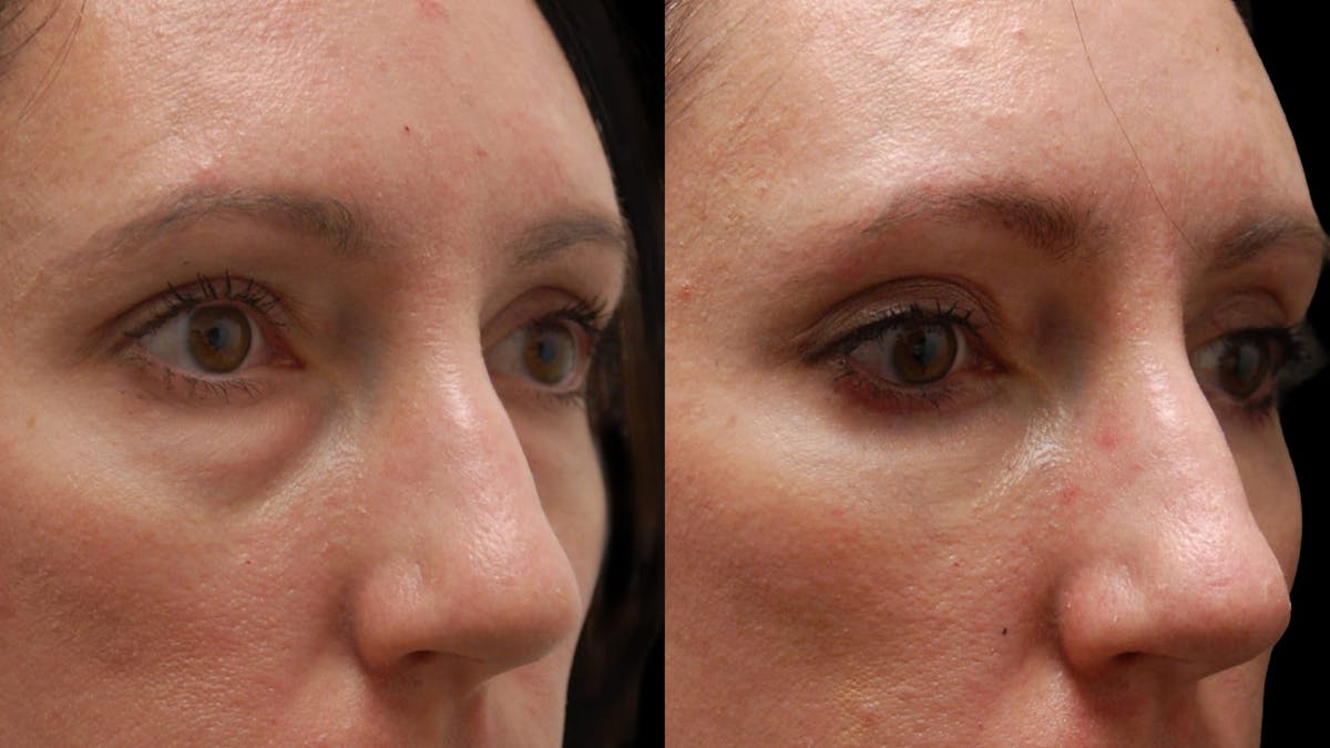 Lower Eyelid Surgery Before & After Gallery - Patient 112109 - Image 8