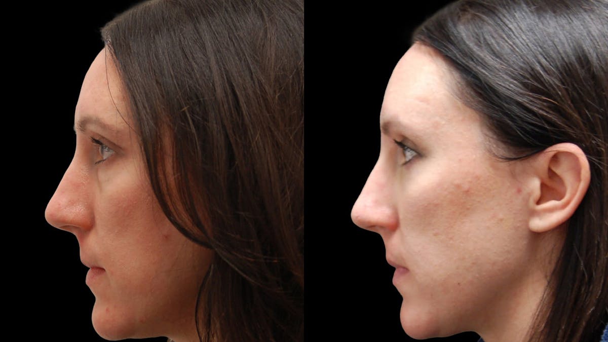 Lower Eyelid Surgery Before & After Gallery - Patient 112109 - Image 4