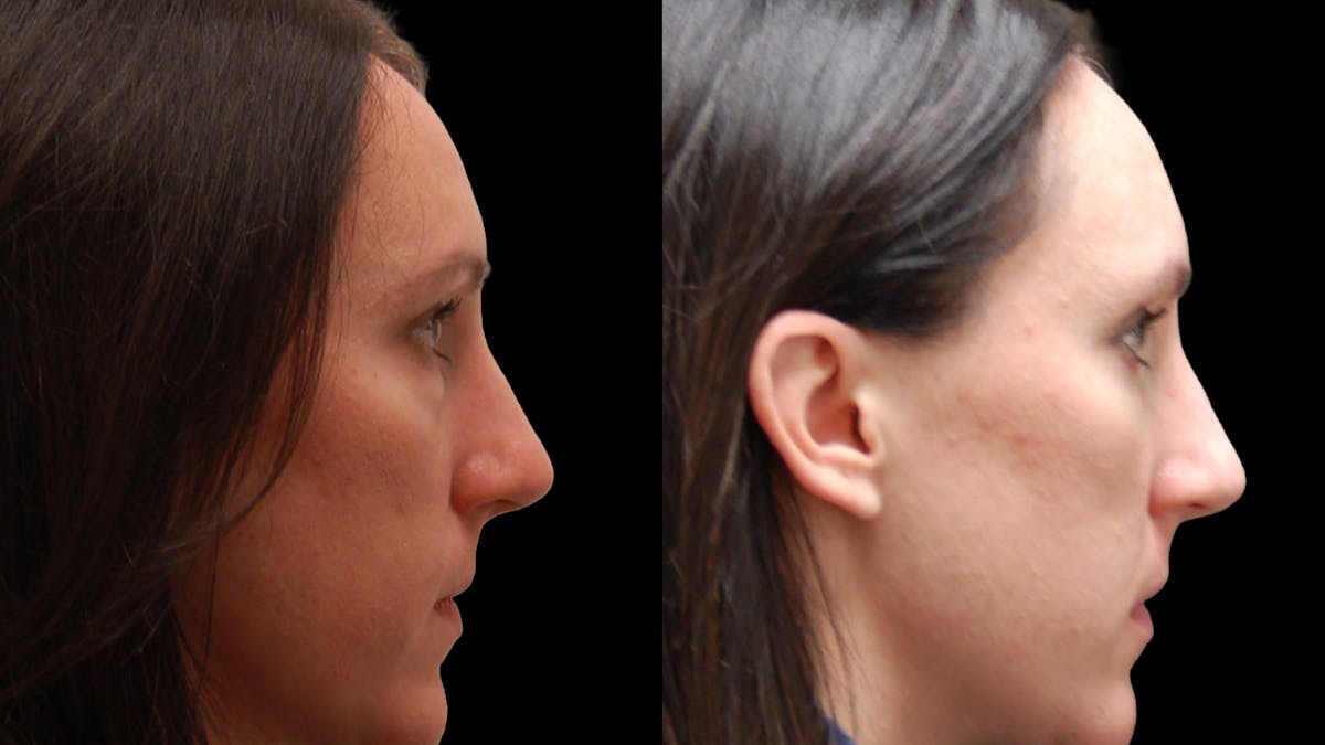 Lower Eyelid Surgery Before & After Gallery - Patient 112109 - Image 6