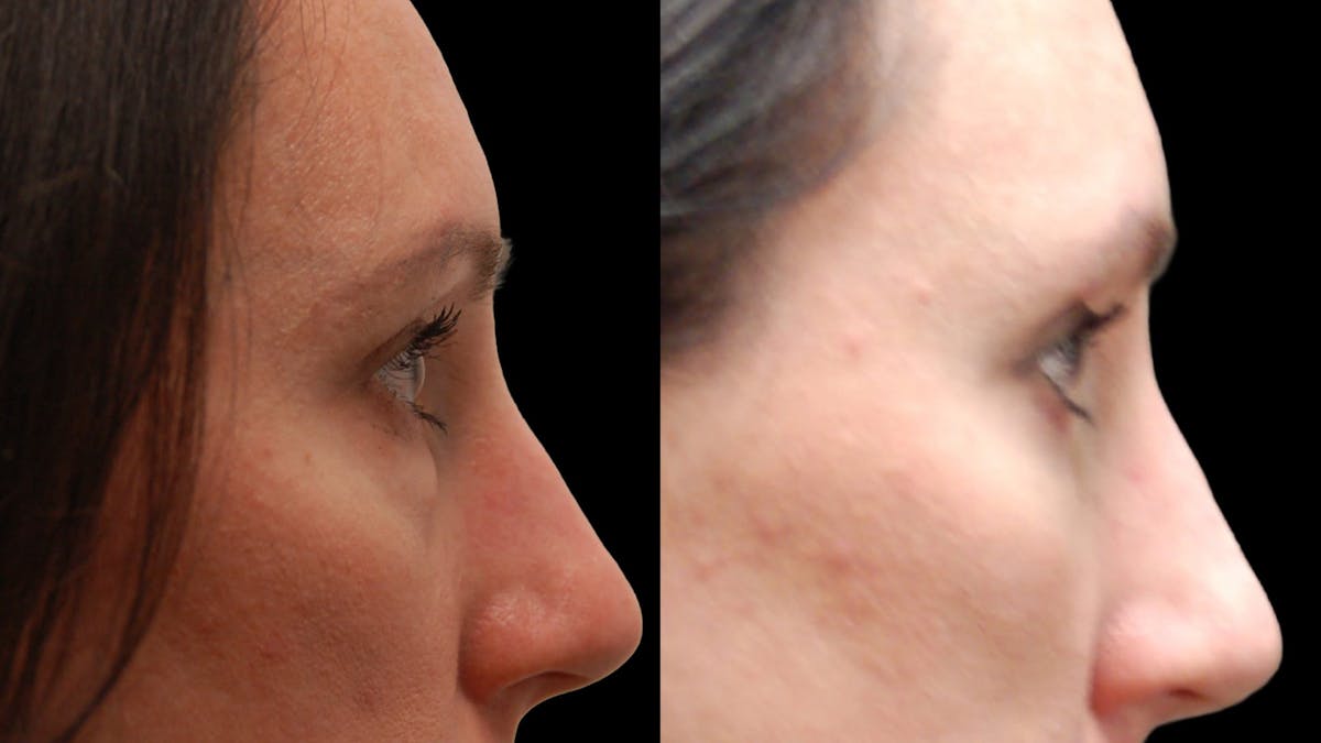 Lower Eyelid Surgery Before & After Gallery - Patient 112109 - Image 7