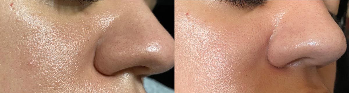 Microneedling Before & After Gallery - Patient 418312 - Image 1