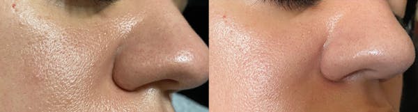 Microneedling Before & After Gallery - Patient 418312 - Image 1