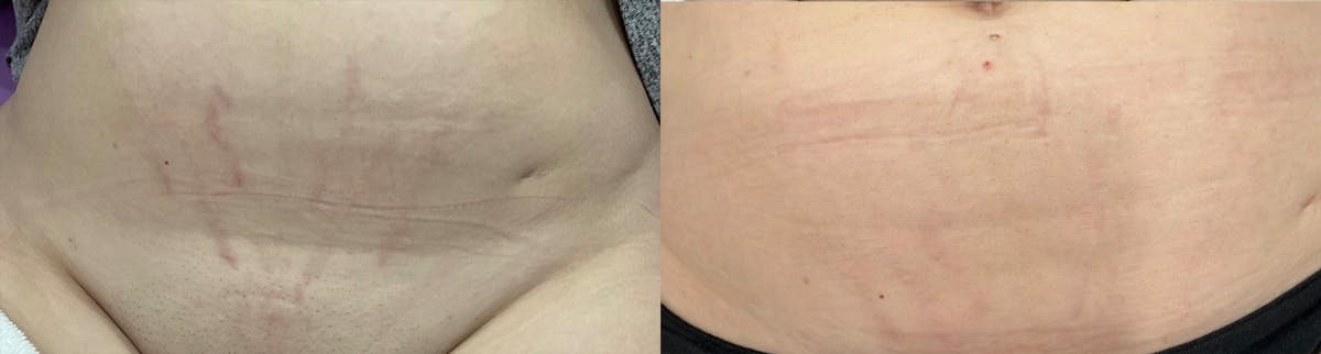 Microneedling Before & After Gallery - Patient 346054 - Image 1