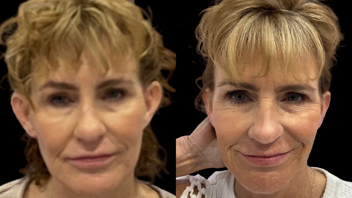 Otoplasty Before & After Gallery - Patient 254111 - Image 1