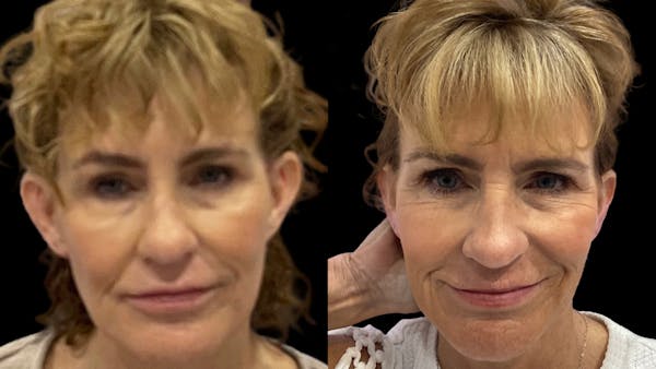 Otoplasty Before & After Gallery - Patient 254111 - Image 1