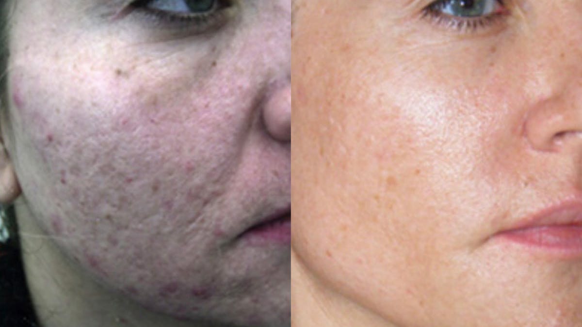 Procell Therapies Before & After Gallery - Patient 160144 - Image 1