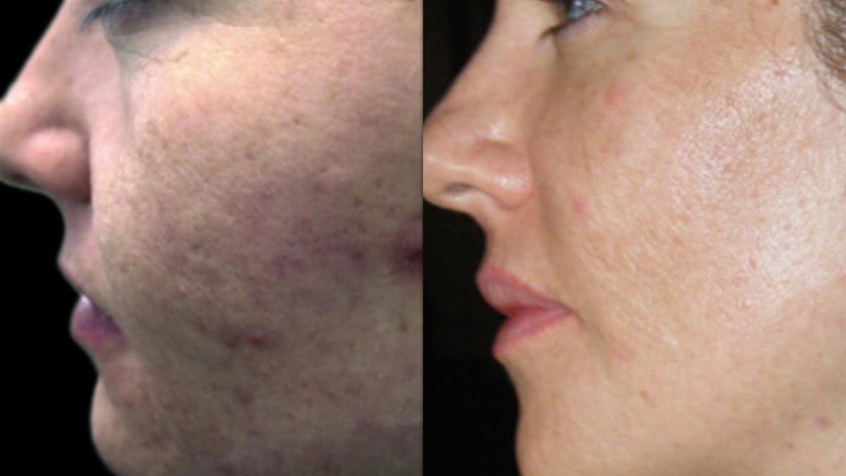 Procell Therapies Before & After Gallery - Patient 160144 - Image 2