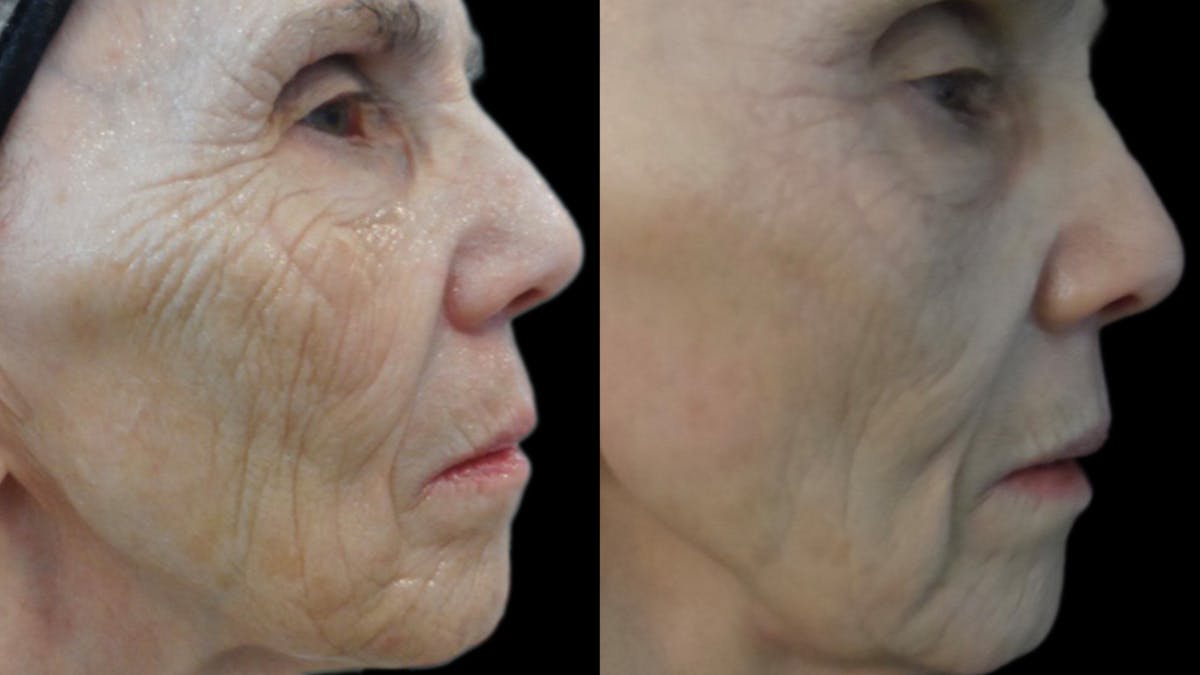 Procell Therapies Before & After Gallery - Patient 303599 - Image 2