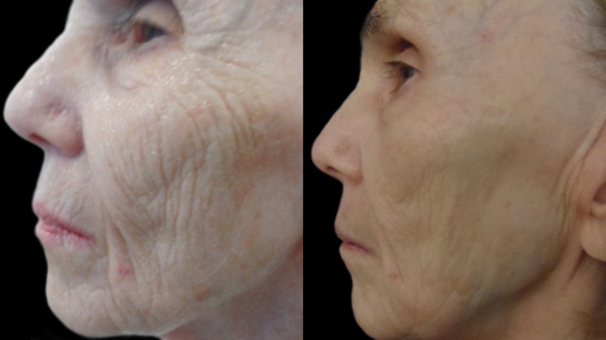 Procell Therapies Before & After Gallery - Patient 303599 - Image 1