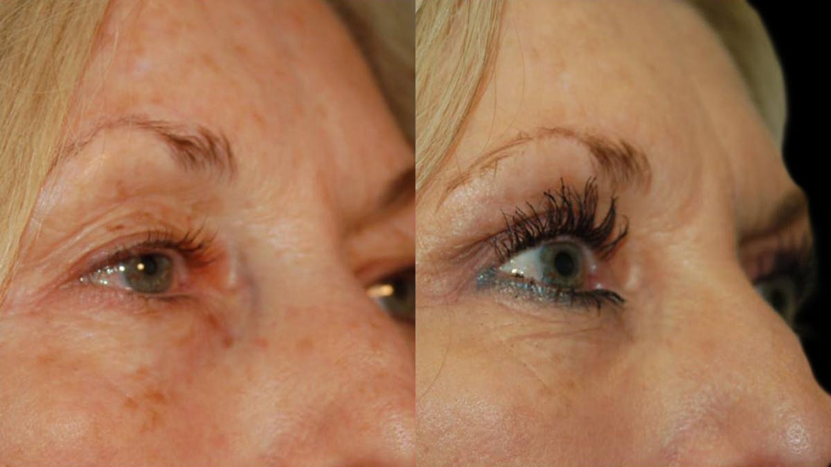Upper Eyelid Surgery Before & After Gallery - Patient 381320 - Image 3