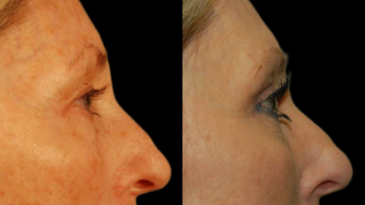 Upper Eyelid Surgery Before & After Gallery - Patient 381320 - Image 2
