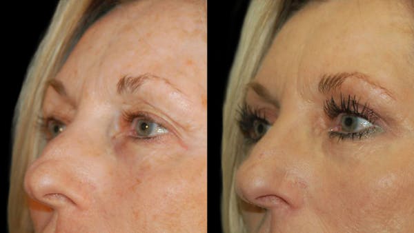 Upper Eyelid Surgery Before & After Gallery - Patient 381320 - Image 1