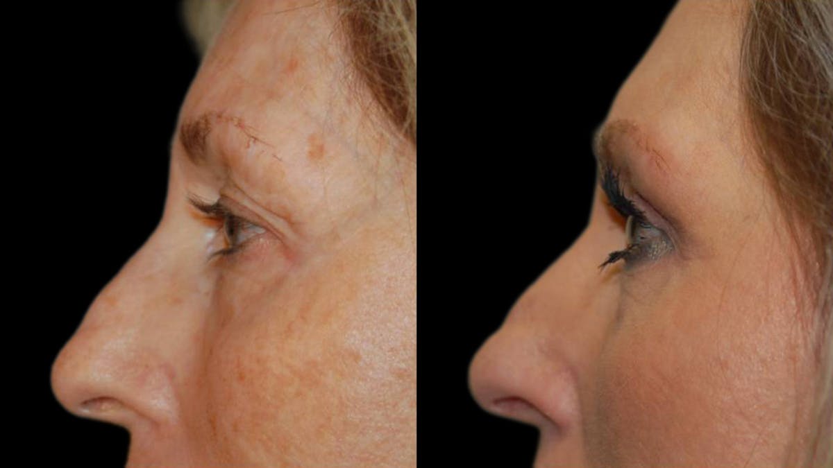 Upper Eyelid Surgery Before & After Gallery - Patient 381320 - Image 4