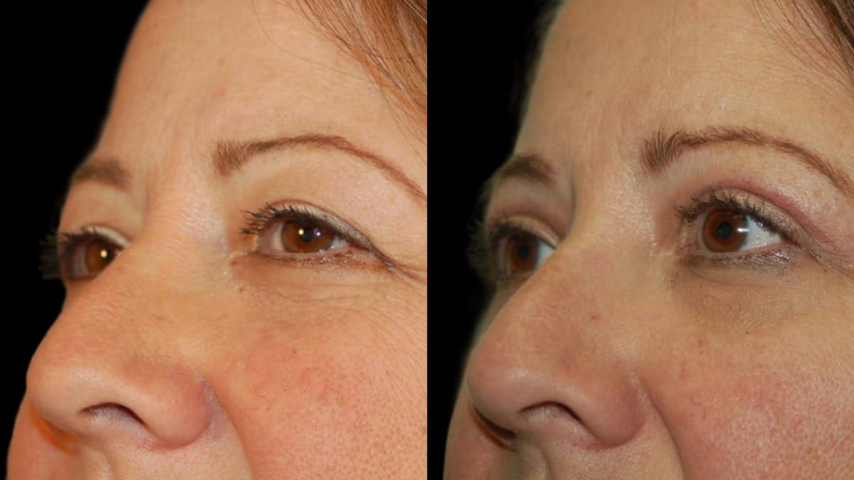 Upper Eyelid Surgery Before & After Gallery - Patient 405531 - Image 1