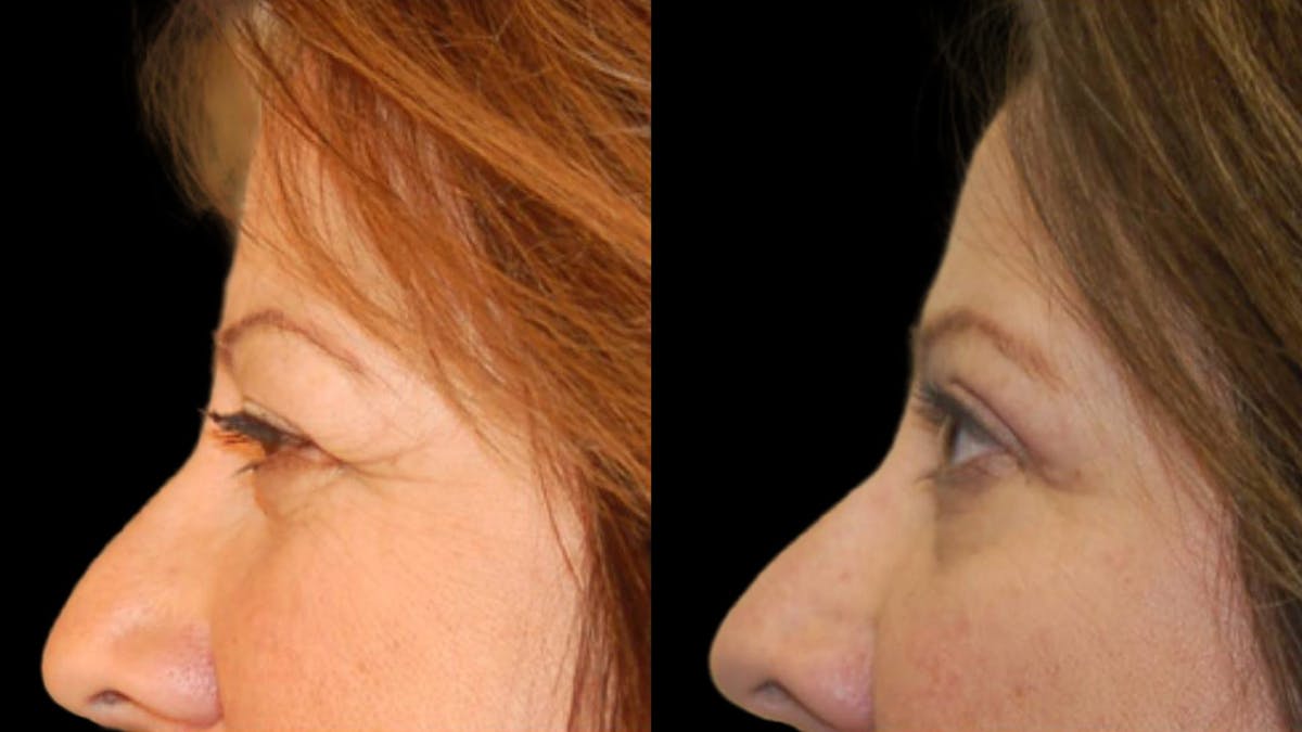 Upper Eyelid Surgery Before & After Gallery - Patient 405531 - Image 4