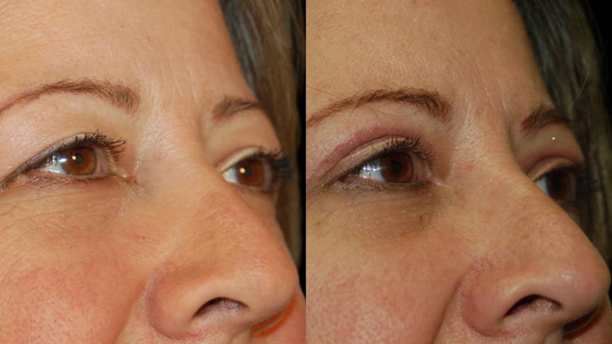 Upper Eyelid Surgery Before & After Gallery - Patient 405531 - Image 3