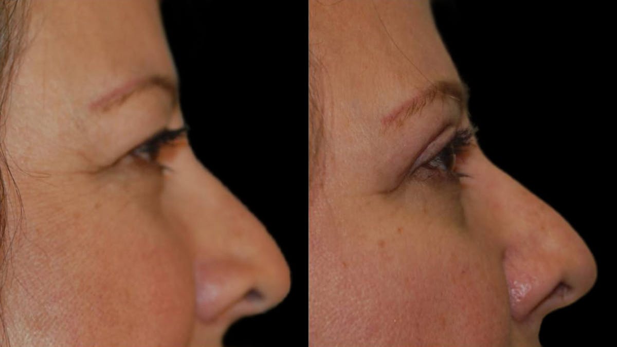 Upper Eyelid Surgery Before & After Gallery - Patient 405531 - Image 2