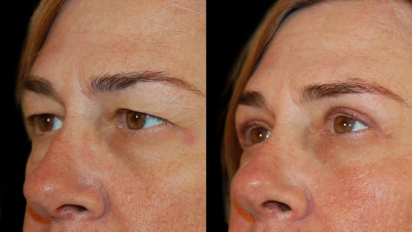 Upper Eyelid Surgery Before & After Gallery - Patient 260006 - Image 1