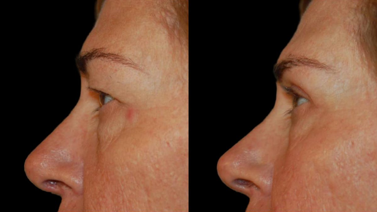 Upper Eyelid Surgery Before & After Gallery - Patient 260006 - Image 4