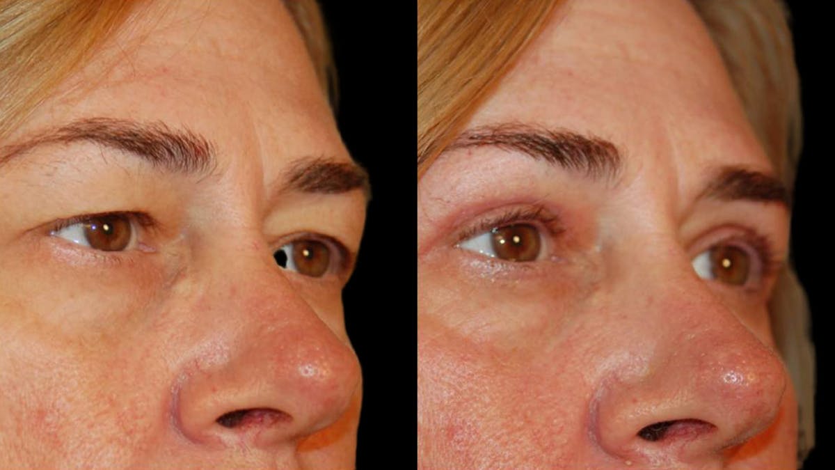 Upper Eyelid Surgery Before & After Gallery - Patient 260006 - Image 2