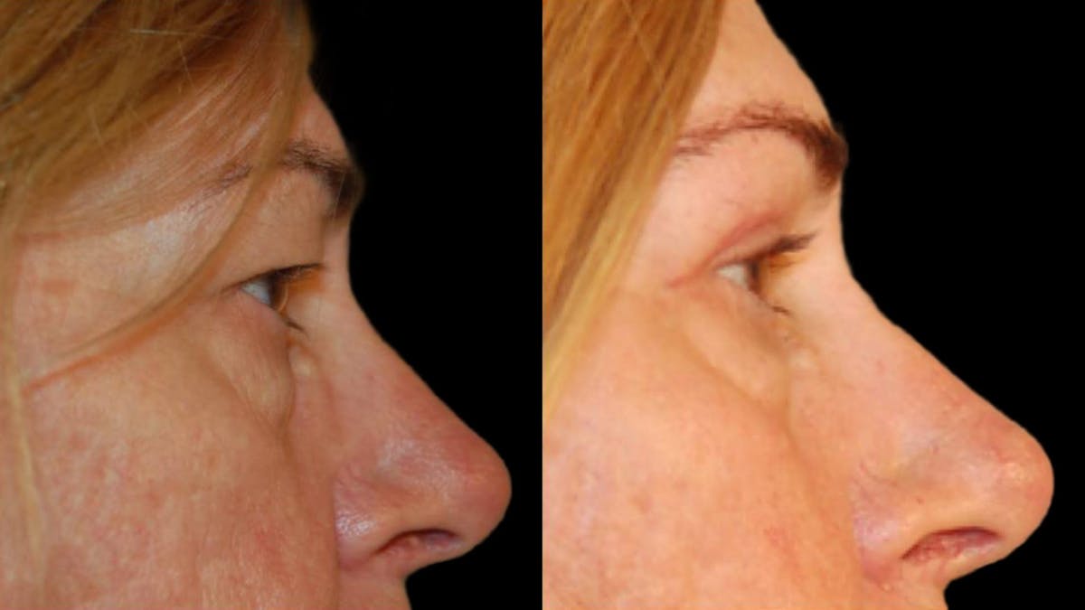 Upper Eyelid Surgery Before & After Gallery - Patient 260006 - Image 3