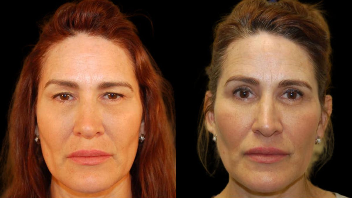 Upper Eyelid Surgery Before & After Gallery - Patient 156985 - Image 2