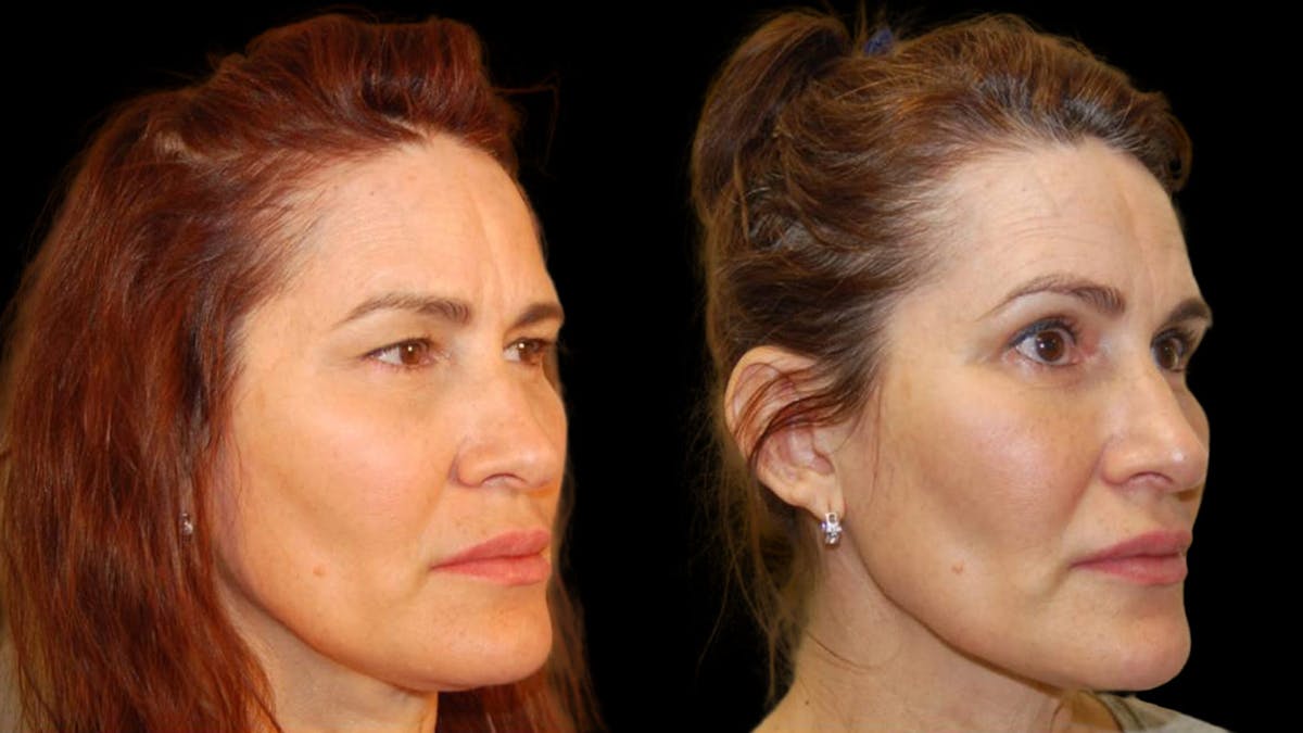 Upper Eyelid Surgery Before & After Gallery - Patient 156985 - Image 6
