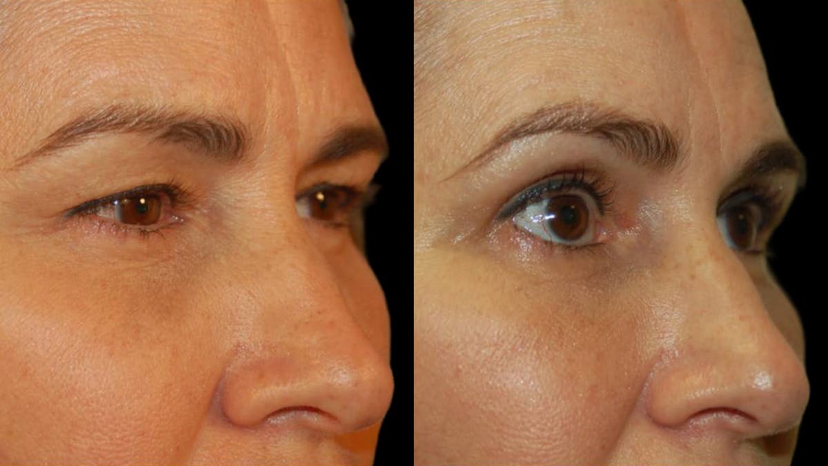 Upper Eyelid Surgery Before & After Gallery - Patient 156985 - Image 7