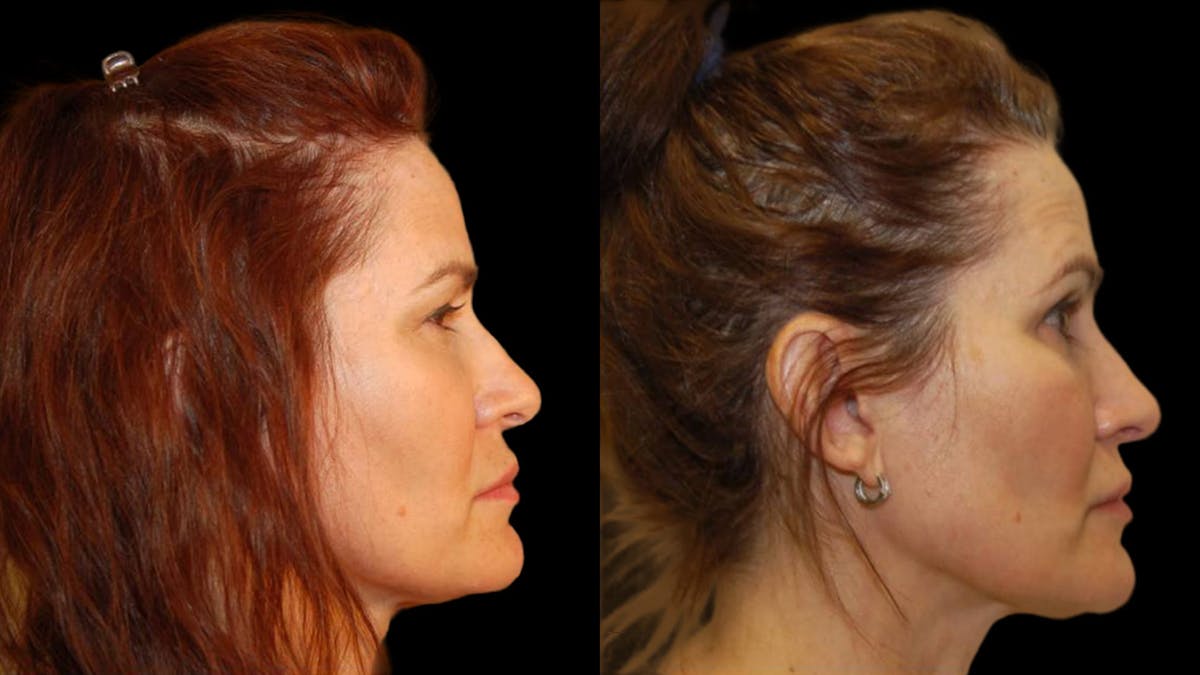 Upper Eyelid Surgery Before & After Gallery - Patient 156985 - Image 3