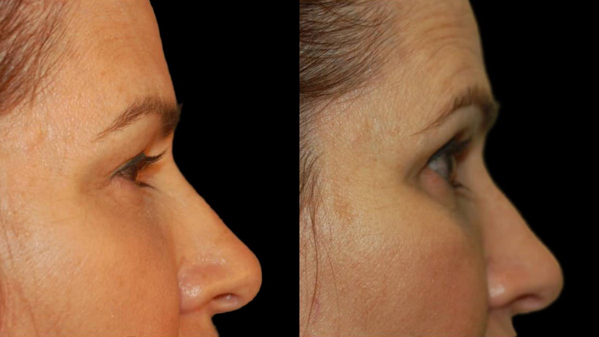 Upper Eyelid Surgery Before & After Gallery - Patient 156985 - Image 4
