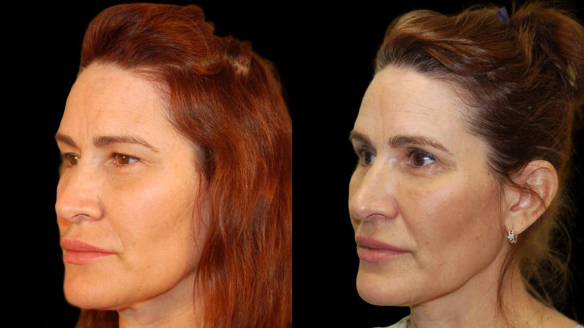 Upper Eyelid Surgery Before & After Gallery - Patient 156985 - Image 1