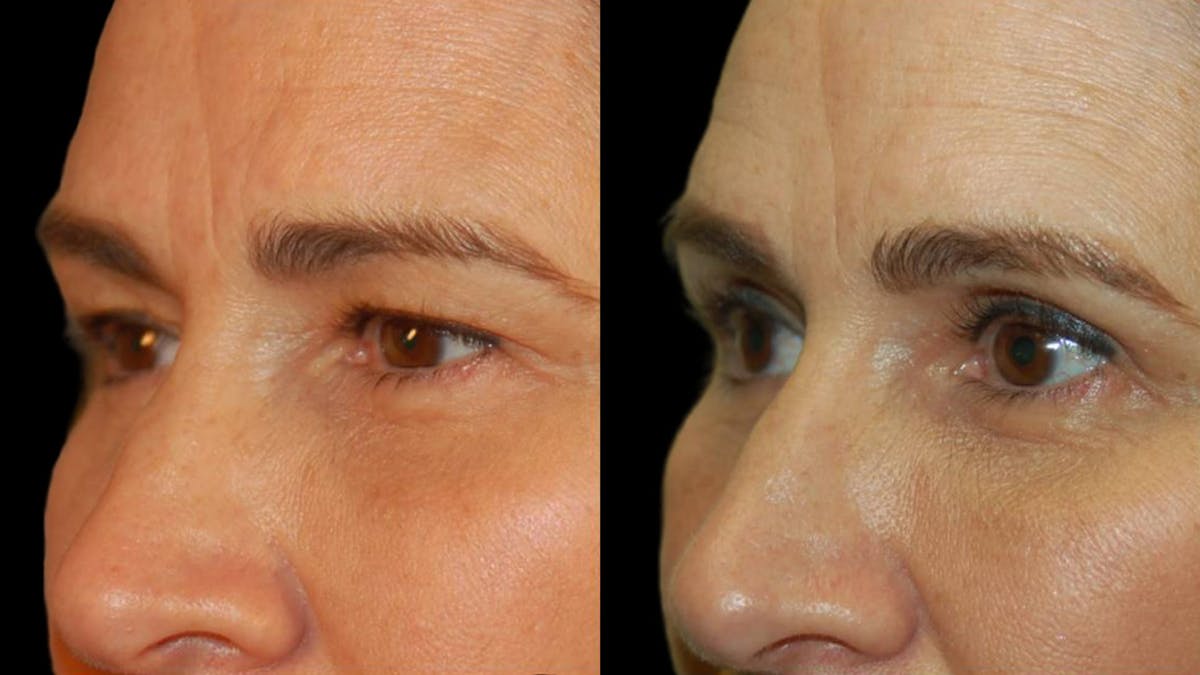 Upper Eyelid Surgery Before & After Gallery - Patient 156985 - Image 5