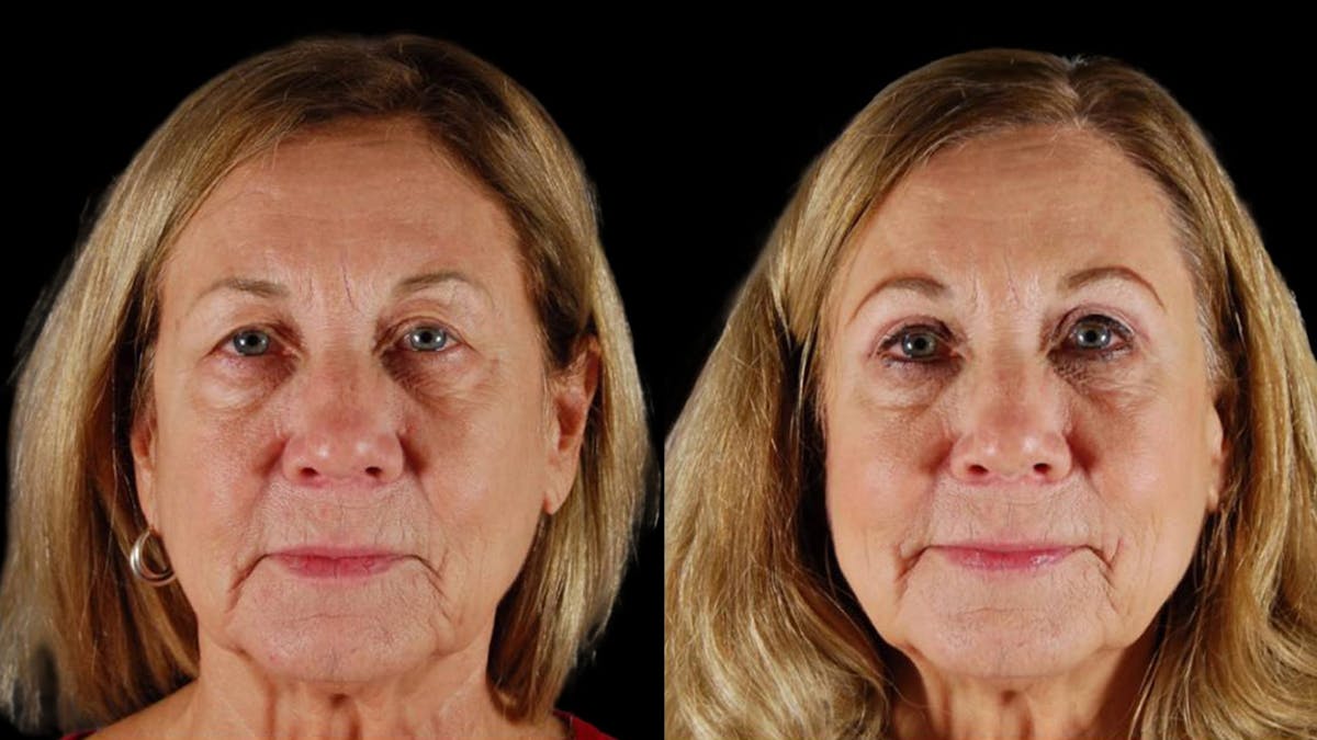 Upper Eyelid Surgery Before & After Gallery - Patient 334853 - Image 2