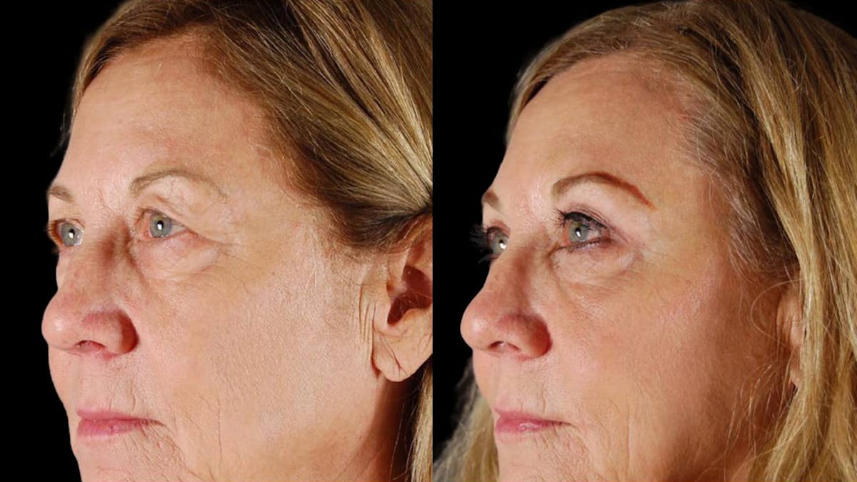 Upper Eyelid Surgery Before & After Gallery - Patient 334853 - Image 1