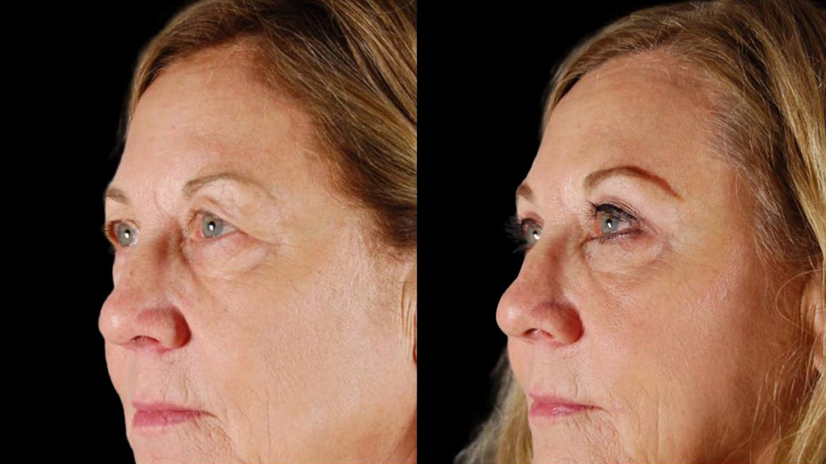 Upper Eyelid Surgery Before & After Gallery - Patient 334853 - Image 3