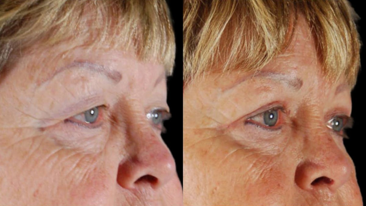 Upper Eyelid Surgery Before & After Gallery - Patient 350657 - Image 2